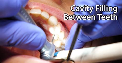 How Long Does It Take To Get 4 Cavities Filled How To Help Your Child
