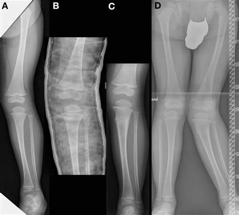 Boy 2 Years And 9 Months Old With A Greenstick Fracture Of The