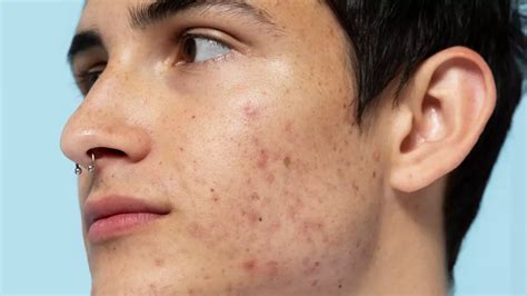 Best Acne Treatments And Tips Suggested By Dermatologists