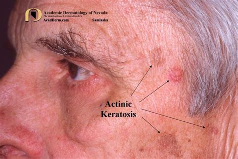 Actinic Keratosis What Is It Academic Dermatology Of Nevada