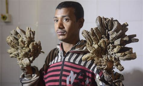 ‘tree Man Set For Life Changing Surgery In Bangladesh