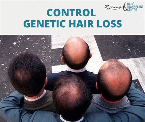 Update More Than 74 Genetic Hair Loss Ineteachers