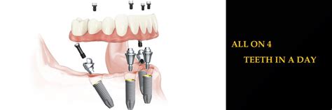 Dental Implants In Surprise AZ Surprise Family Dentistry