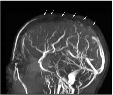 Cerebral Venous Sinus Thrombosis Obgyn Key