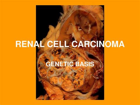 Ppt Renal Cell Carcinoma Powerpoint Presentation Free Download Id