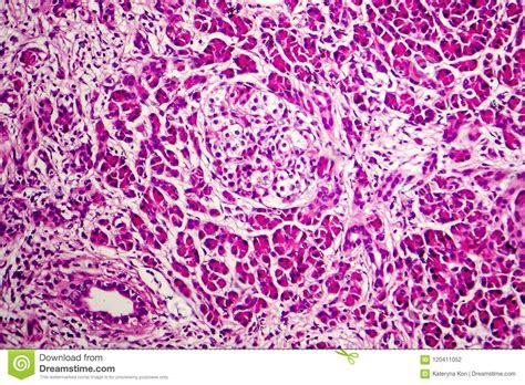 Acute Hemorrhagic Pancreatitis Stock Photo Image Of Hematoxylin