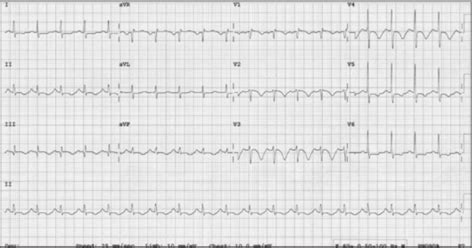 Pulmonary Embolism Dont Throw Out That Ekg — Nuem Blog