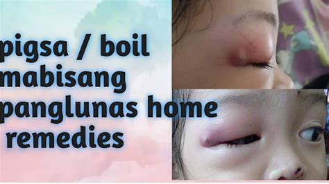 Pigsa Boil Mabisang Panlunas Home Remedies Wag Natin Pabayaan Ang