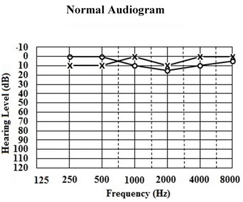 How To Read An Audiogram What Do The Results Mean Trusted Advice