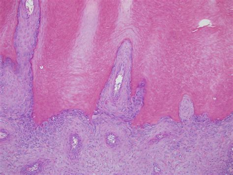 Pathology Outlines Cutaneous Horn