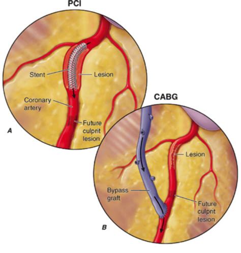 Coronary Artery Bypass Grafting Cabg Flashcards Quizlet