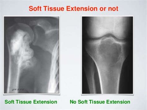 Musculoskeletal Tumors