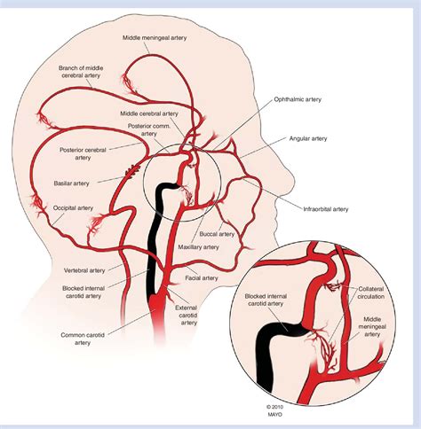 There are two carotid arteries: Figure 2 from Carotid artery disease: stenting vs endarterectomy. | Semantic Scholar