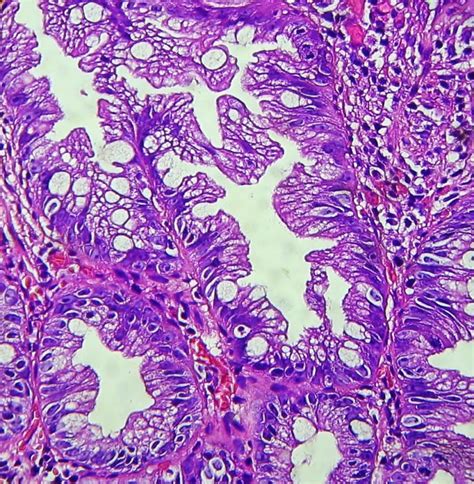 gastrointestinal and liver histology pathology atlas colon hyperplastic polyp