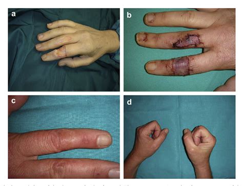 Figure 1 From Management Of Full Thickness Skin Defects In The Hand And