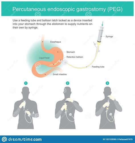 Percutaneous Endoscopic Gastrostomy Peg Stock Vector