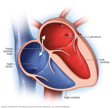 Patent Foramen Ovale Symptoms And Causes Mayo Clinic