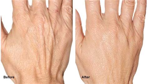 Radiesse Hands Up For Spring Comprehensive Dermatology Center Of