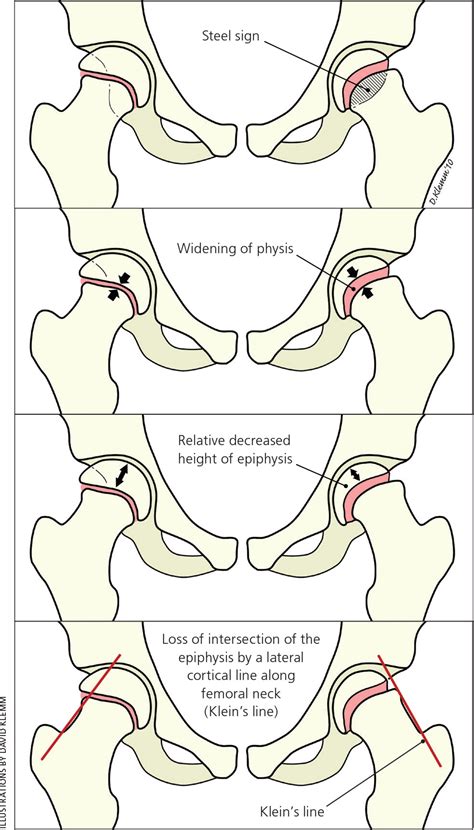 Slipped Capital Femoral Epiphysis Diagnosis And Management Aafp