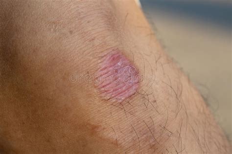 Folliculitis On Human Skin Stock Photo Image Of Acne 92850996