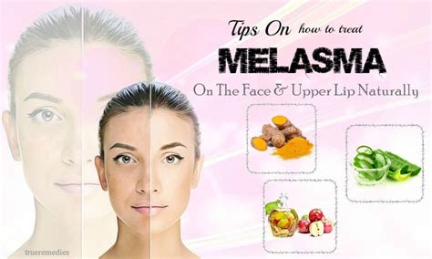 10 Tips On How To Treat Melasma On The Face And Upper Lip