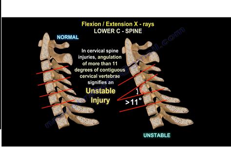 Cervical Spine Instability —