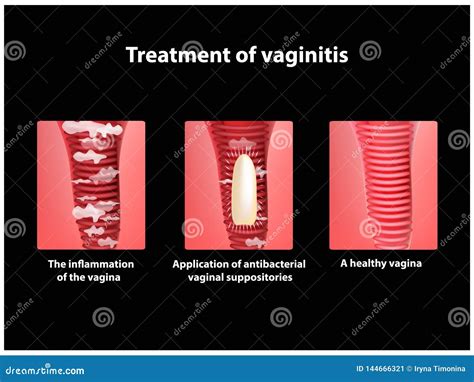 Treatment Of Vaginitis Suppositories Inflammation The Vagina Infographics Vector Illustration