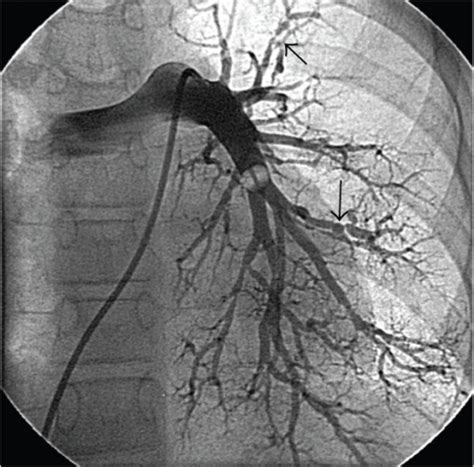 Left Main Pulmonary Angiogram Demonstrating Extensive D Open I