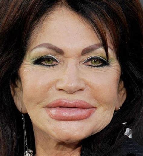 Horrifying Results Of Terrible Plastic Surgery Wtf Gallery Botched