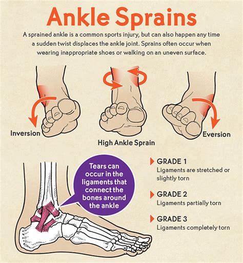 Ankle Injuries And Disorders Pictures