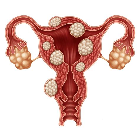 Uterine Fibroids What They Are When They Need To Be Treated And Options Evergreen Women S