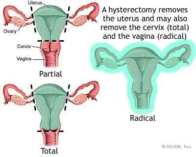 Endometriosis Hysterectomy Endometriosis Health Information Ny