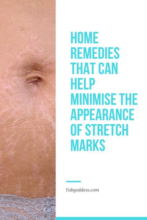 How To Get Rid Of Stretch Marks Causes And Treatments In 2020 How To