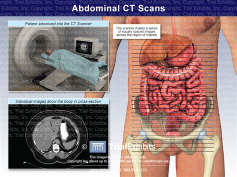 abdominal ct scans trial exhibits inc