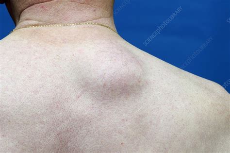 Lipoma On The Upper Back Stock Image C0103308 Science Photo Library