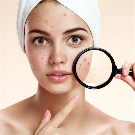 cystic acne remedies cystic acne treatment home remedies for acne skin care remedies natural