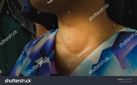 Anterior Next Swelling Thyroid Goitre Stock Photo 1273310203 Shutterstock