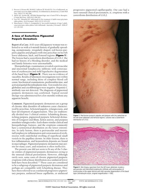 A Case Of Zosteriform Pigmented Purpuric Dermatosis Dermatology