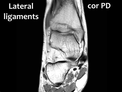 The Radiology Assistant Ankle Mri Examination