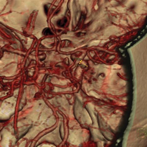 Dual Energy Ct Angiography In The Evaluation Of Intracranial Aneurysms Image Quality Radiation