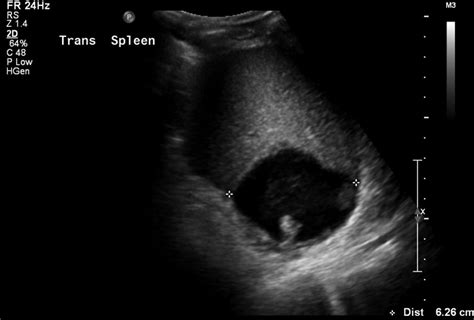 Splenic Abscess Detection And Monitoring Using Sonography Elizabeth