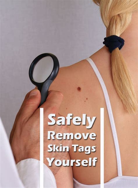 5 best methods for safely removing skin tags yourself the health science journal