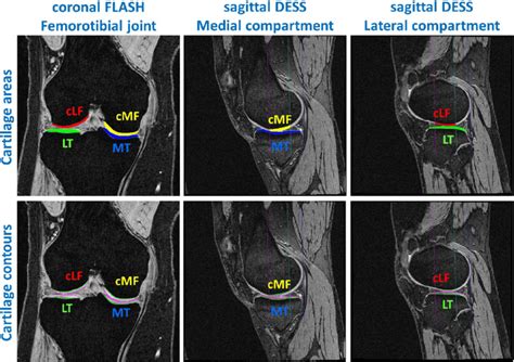 Manual Segmentation Of The Femorotibial Cartilages Mt Lt