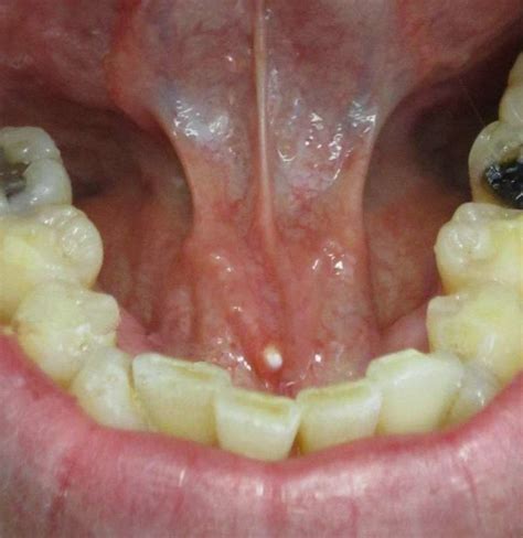 why is my under tongue swollen causes and remedies
