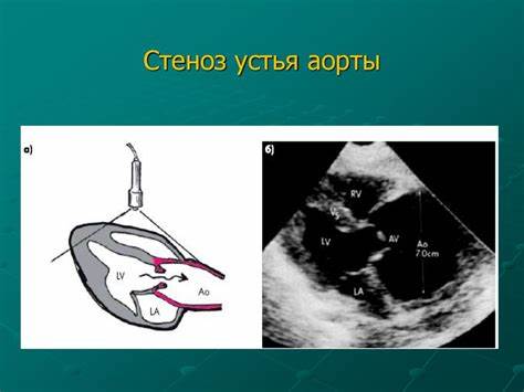 Диета при стенозе устья аорты Ведение беременности и родов при пороках сердца. Кардиомиопатии Ведение беременности и родов при пороках сердца. Кардиомиопатии Диета при стенозе устья аорты
