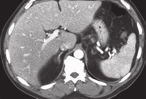 Ct Scan Of The Abdomen After Recovery Shows A Normal Spleen Download