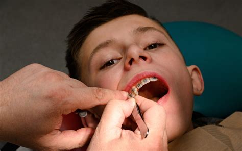 Do Braces Hurt And How Long Do They Hurt Tips To Reduce Pain Or Discomfort