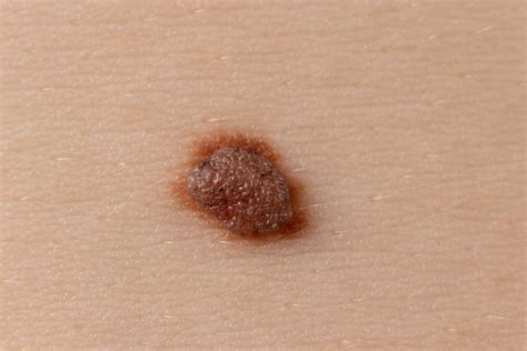 Skin Cancer Screening And Treatment At Lumos Dermatology — Lumos Dermatology®