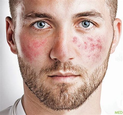 Reducing The Appearing Of Rosacea For Men