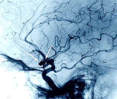 Cerebral Aneurysm Treatment Angiogram Stock Image C Science Photo Library